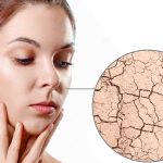Dry skin