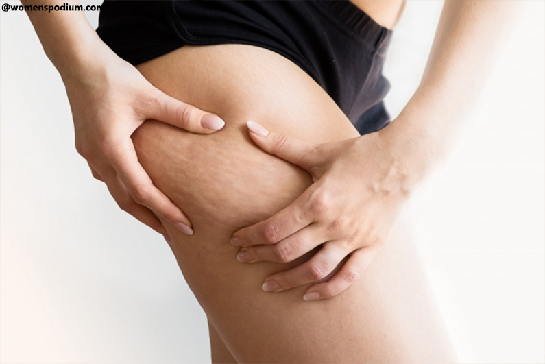 What is Cellulite