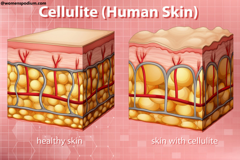 Causes of Cellulite