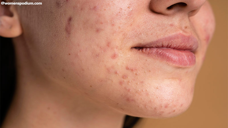 What Causes Acne