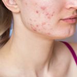 major causes of acne
