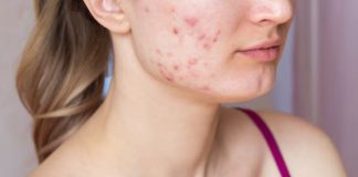 What Are the Common Causes of Acne Breakouts? major causes of acne