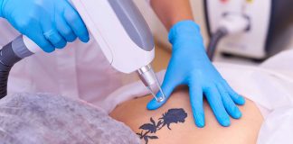 How Laser Tattoo Removal Works? 10 Caveats of Tattoo Removal how laser tattoo removal works