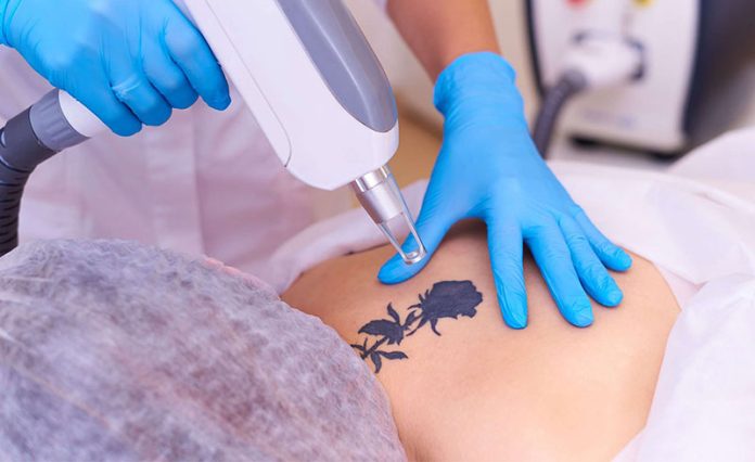 how laser tattoo removal works