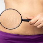 Do Stretch Marks Go Away When You Lose Weight