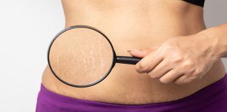 Do Stretch Marks Go Away When You Lose Weight? Causes And Remedies For Women Do Stretch Marks Go Away When You Lose Weight