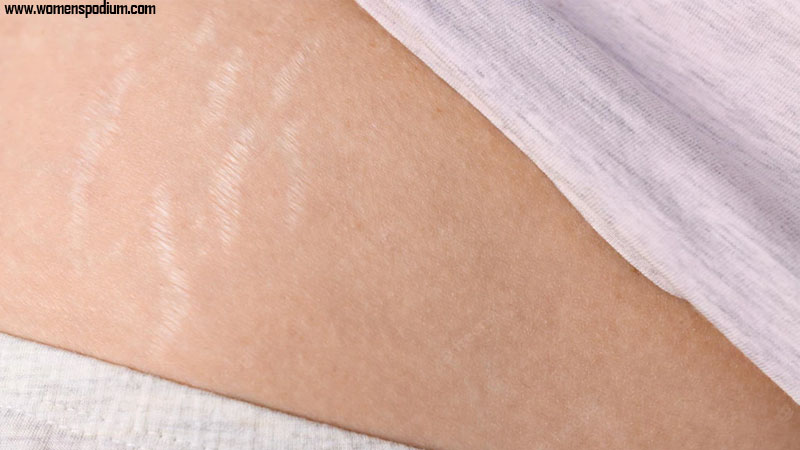 Treat Stretch Marks