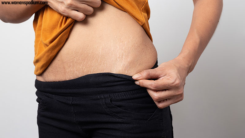 What causes stretch marks - Do Stretch Marks Go Away When You Lose Weight