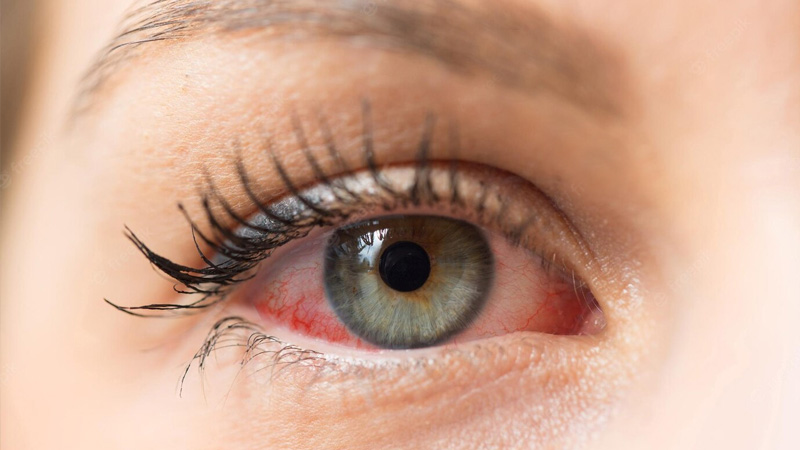 Can Dry Eyes Cause Blindness