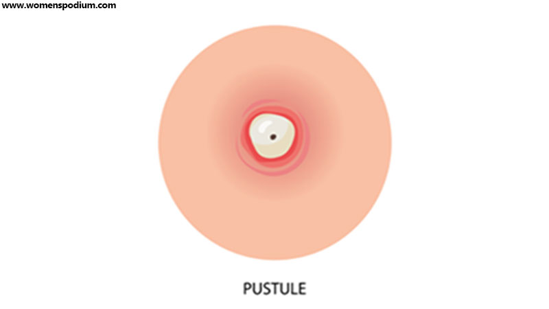 Pustule - different type of acne