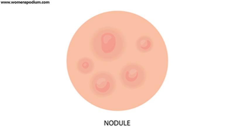 Nodules