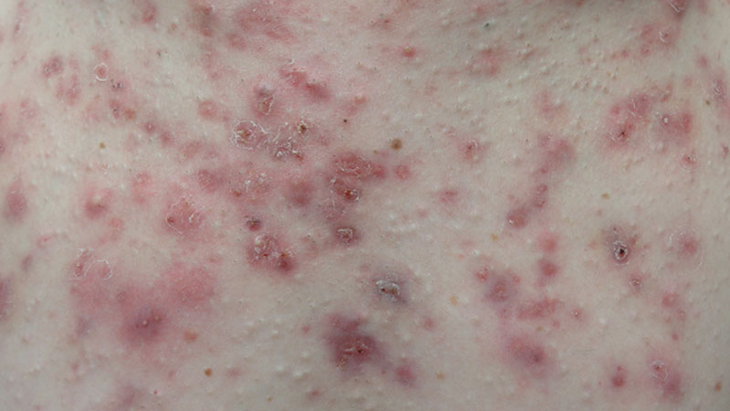 Acne maligna or acne fulminans - rare skin disorder