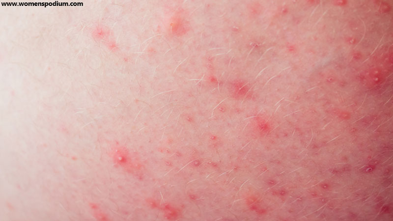 Gram-negative folliculitis is an acne-like disorder