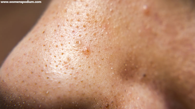 whiteheads and blackheads