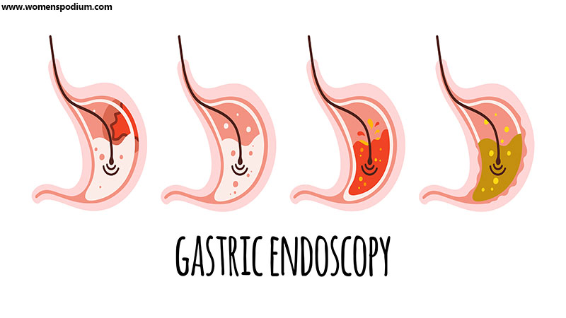 Gastric endoscopy