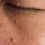 What Causes Cholesterol Deposits? How To Get Rid Of Cholesterol Deposits From Under Your Eyes how-to-get-rid-of-cholesterol-deposits