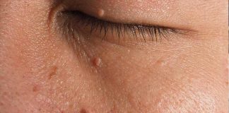 What Causes Cholesterol Deposits? How To Get Rid Of Cholesterol Deposits From Under Your Eyes how-to-get-rid-of-cholesterol-deposits