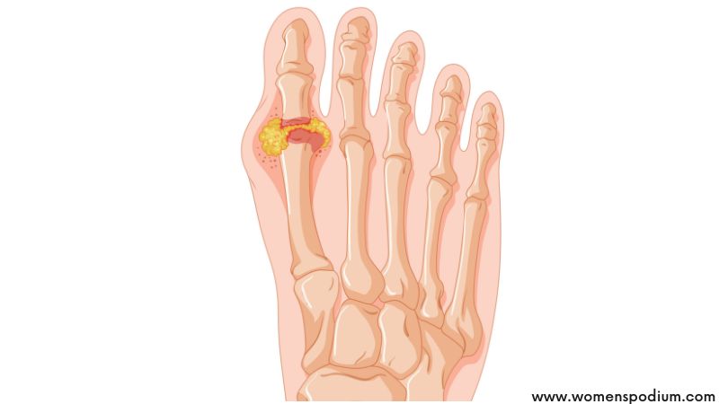 gout and uric acid