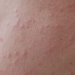 retinoid cream for milia