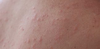 How To Use Retinoid Cream For Milia Treatment? retinoid cream for milia