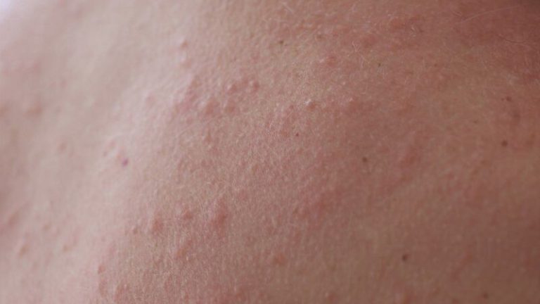 How To Use Retinoid Cream For Milia Treatment? How To Use Retinoid Cream For Milia Treatment?