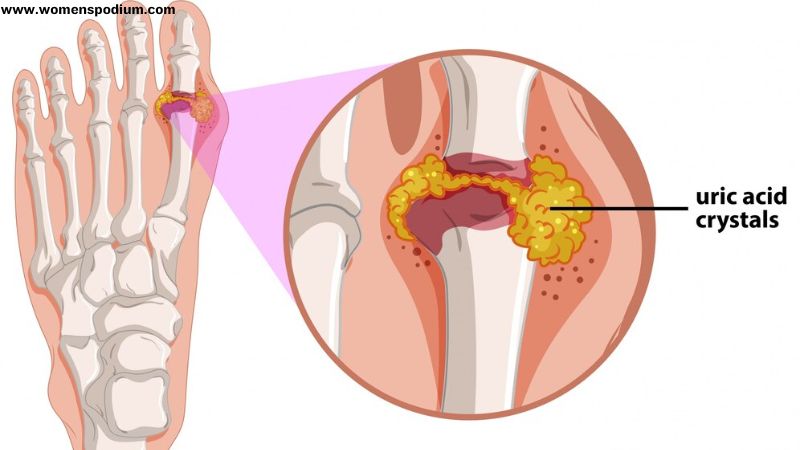 What-Is-Gout-And-Its-Management